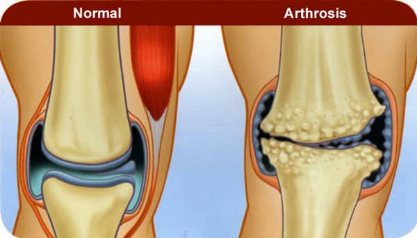 Arthrose epaule