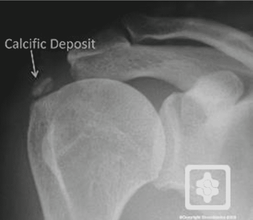 calcification épaule