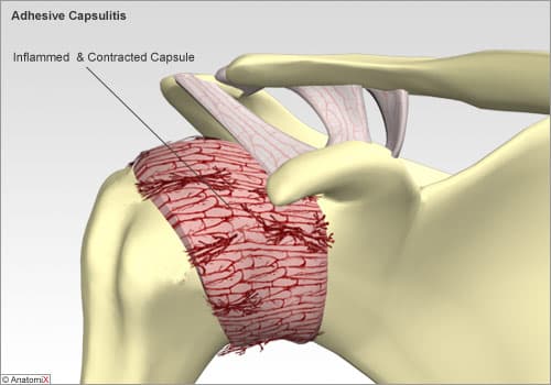 capsulite retractile